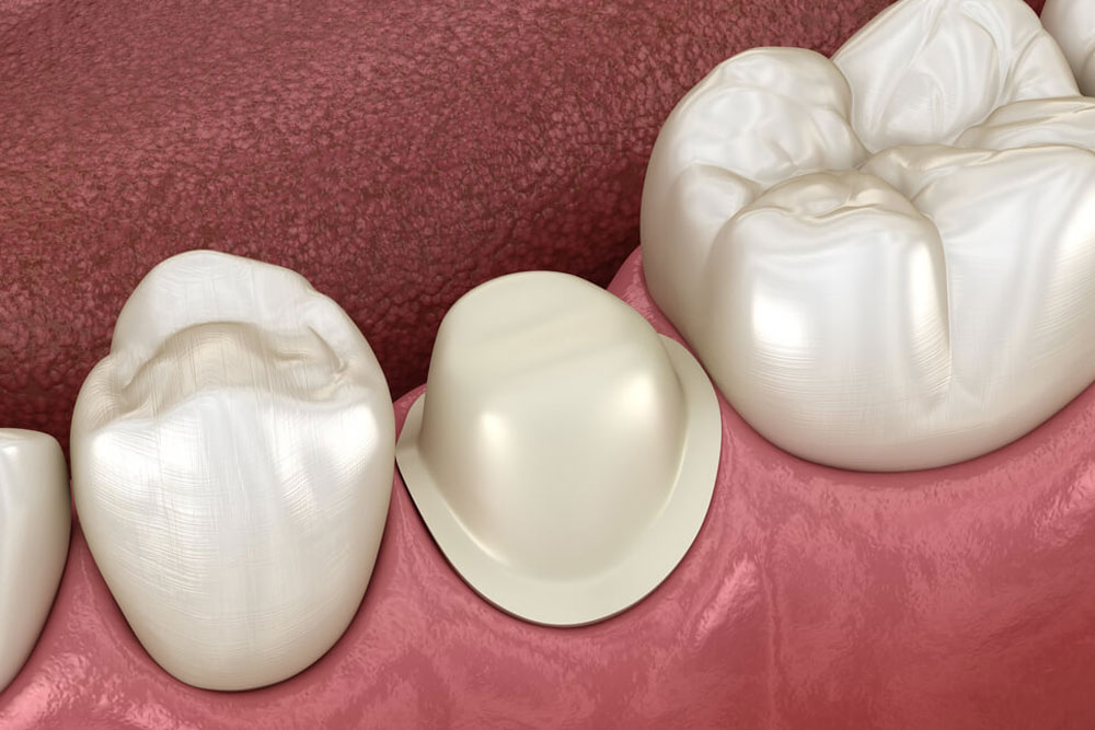 Preparated premolar tooth for dental metal-ceramic crown placement