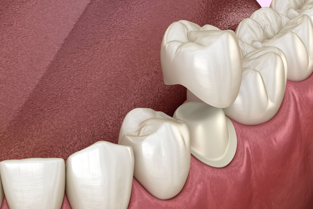 Preparated premolar tooth and dental metal-ceramic crown