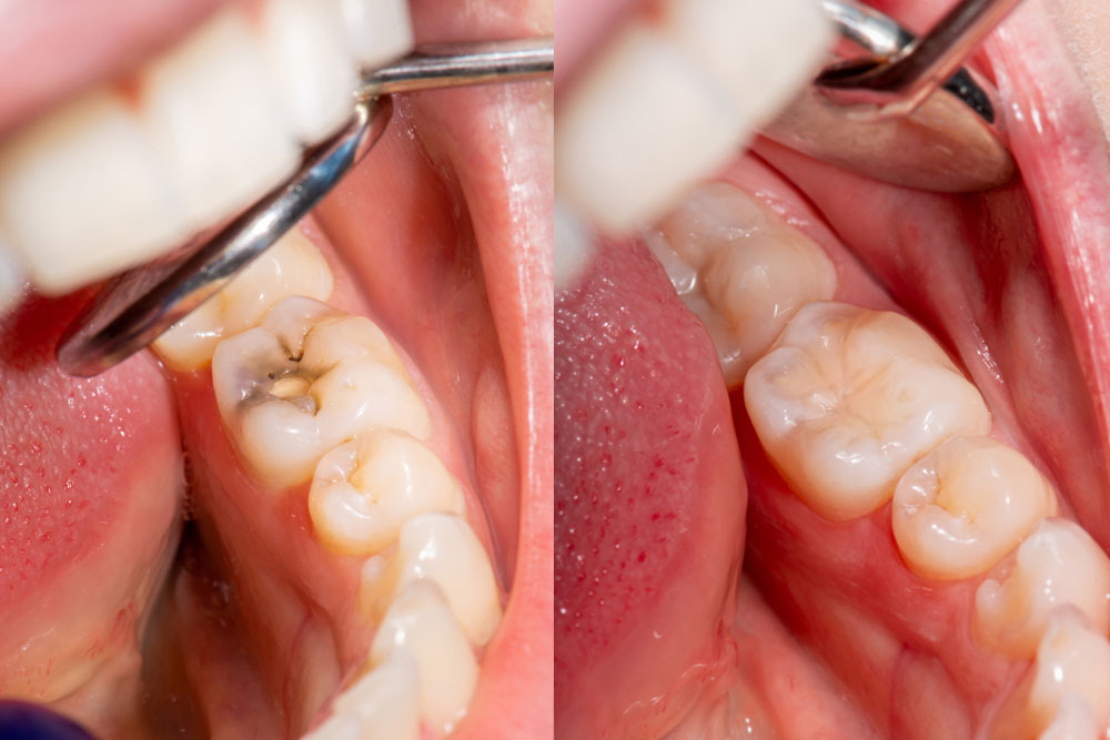 Filling with dental composite photopolymer material using Rubber Dam