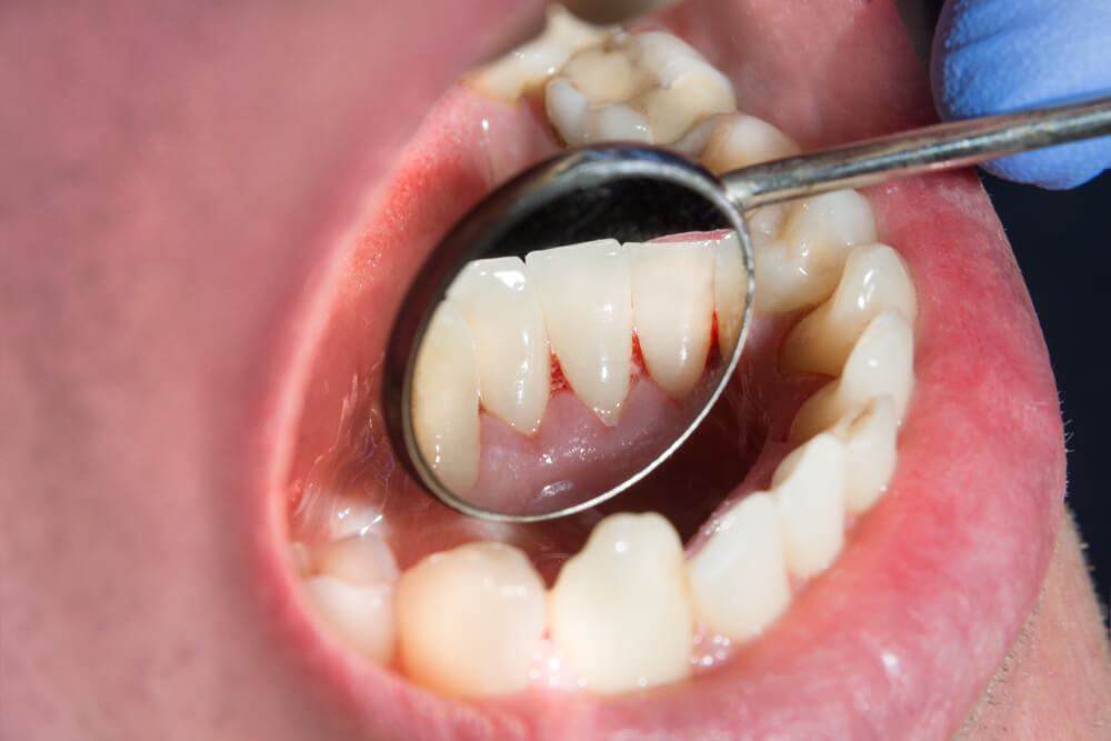 Dentistry treatment of dental plaque