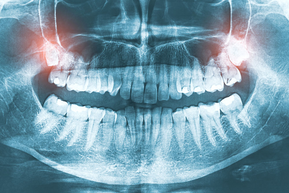 wisdom pain tooth oral dental jaw exam